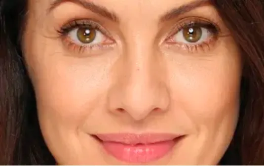 Relleno de ojeras con ácido hialurónico: Para una mirada descansada y segura